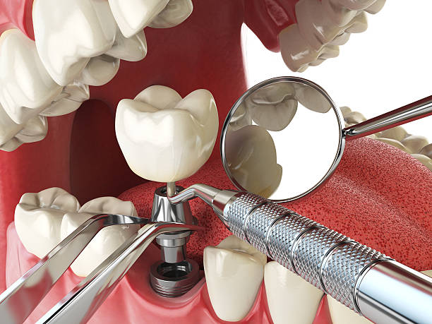 Best Root Canal Emergency Dentist  in Potterville, MI